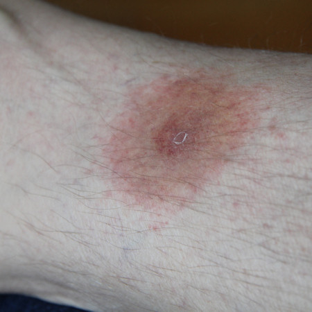 Tick bite after 10 days